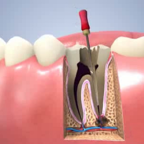 {Endodonti (Kanal Tedavisi)}